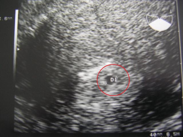妊娠5週目 胎嚢 Hello Mｙ Baby